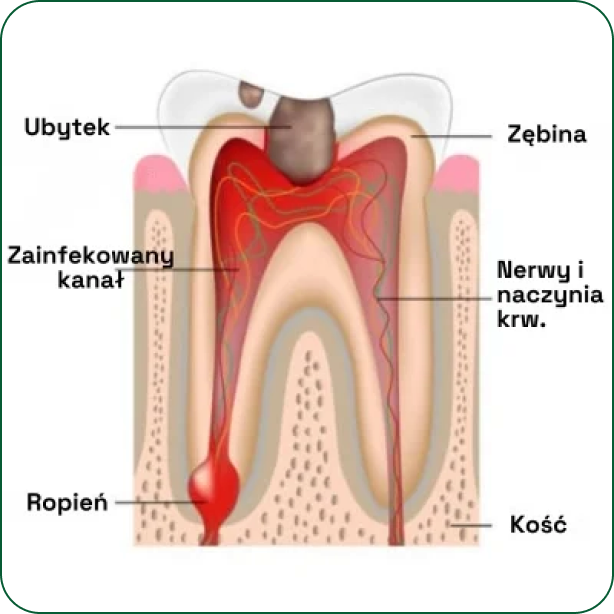 Etap 1: ubytek i zainfekowany kanał zęba — schemat